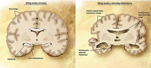 Choroba Alzheimera obraz mozgu